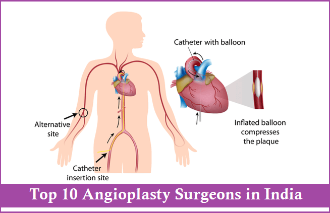 Top 10 Angioplasty Surgeons in India