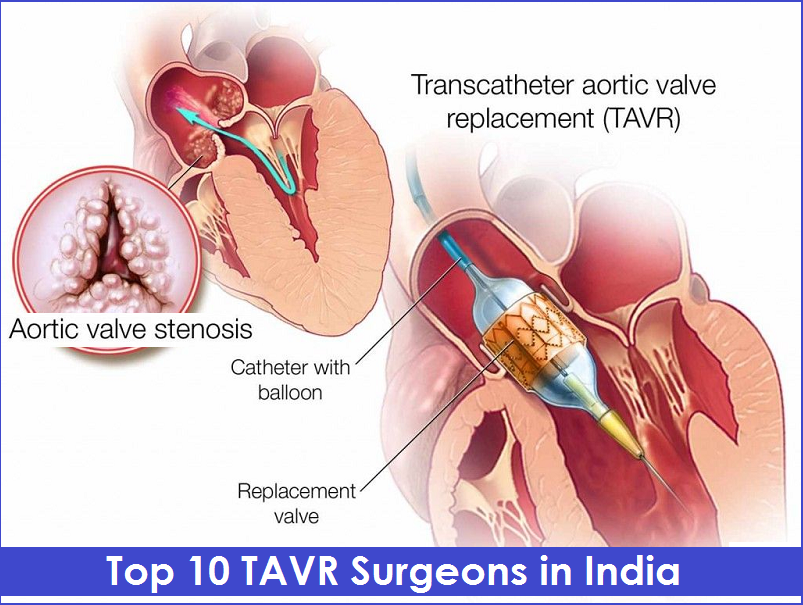 Top TAVR Surgeons in India