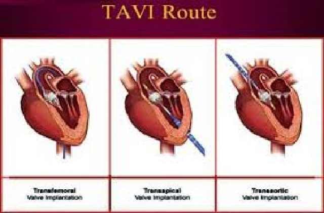 aortic valve Implantation tavi