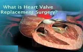 Heart Valve Replacement in India : Read the Facts!